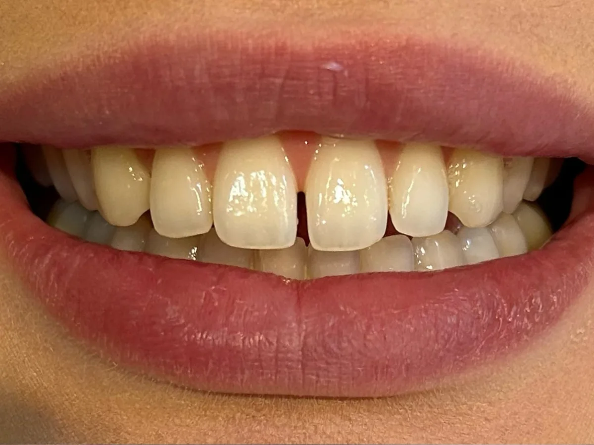 Situação antes, Tratamento com Invisalign