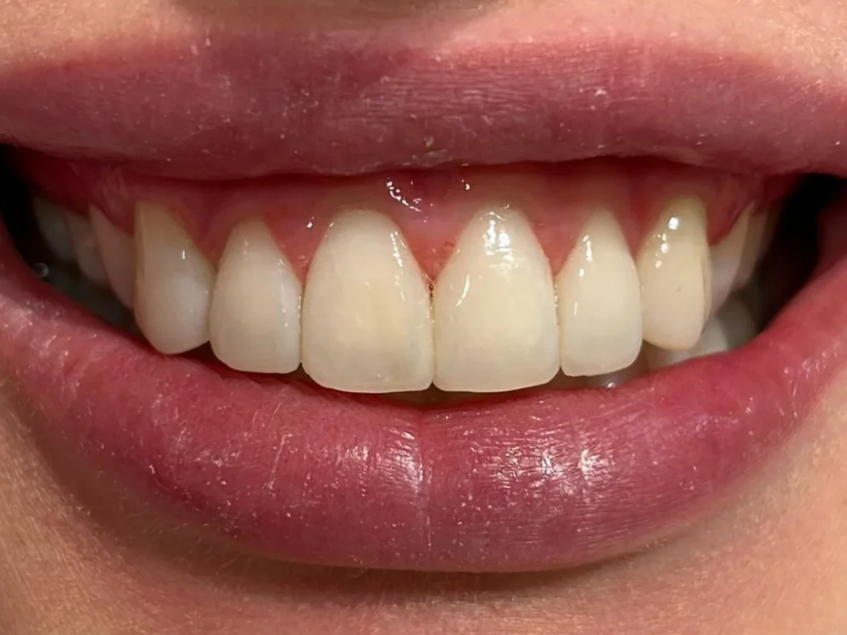 Resultado depois, Tratamento com Invisalign