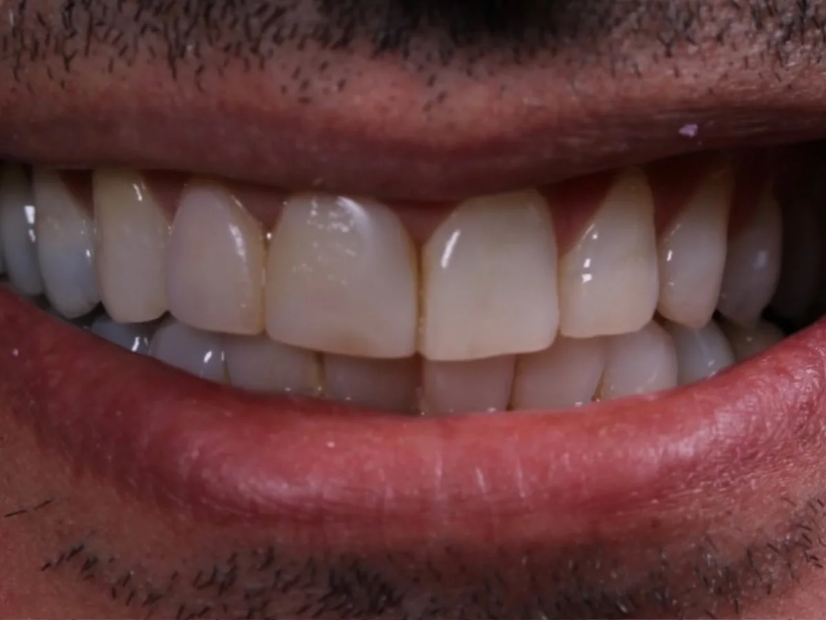 Situação antes, Lentes de contato dental