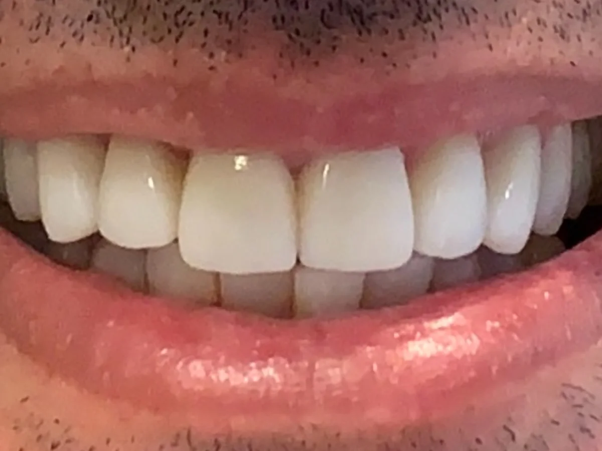 Resultado depois, Lentes de contato dental